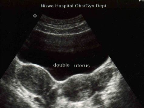 Didelphys Uterus Ultrasound