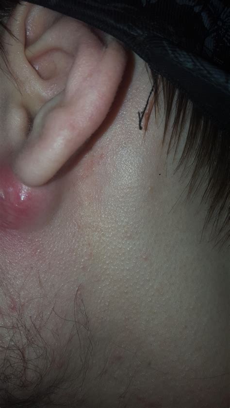 Boil under ear red help!?! – Acne – Acne.org Forum