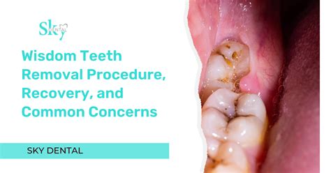 Image result for Wisdom Teeth Removal Procedure