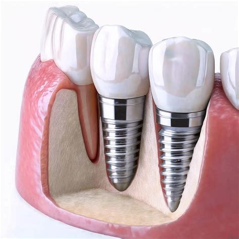 Transosteal Dental Implants