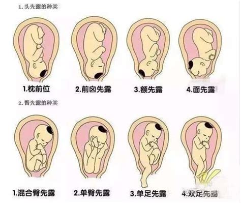 在孕中期遇上妊娠并发症 这10种最让人头疼！ - 知乎