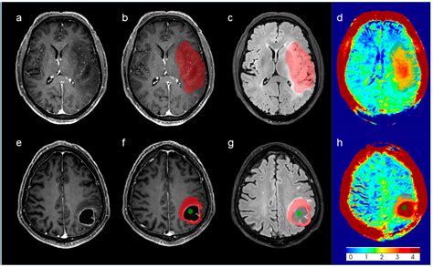 The Role of Amide Proton Transfer (APT)-Weighted Imaging in Glioma ...