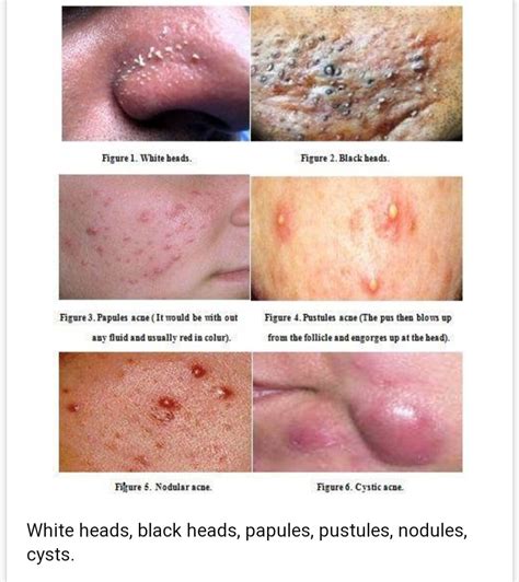 Nail Regeneration ,Hair fall and Acne - CUBE chat - ChatShaala