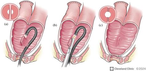 Image result for pouchoscopy