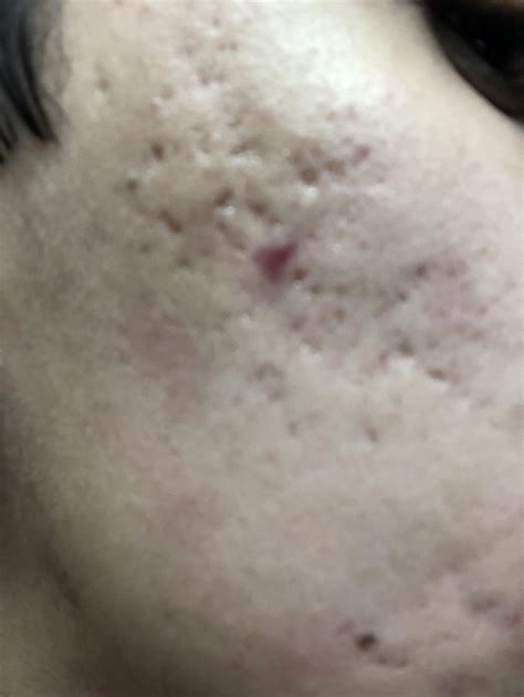 Blood pimple? Was a normal pimple and I left it alone then turned into ...