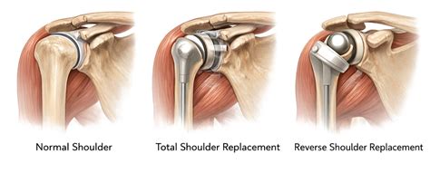 Reverse Shoulder Replacement