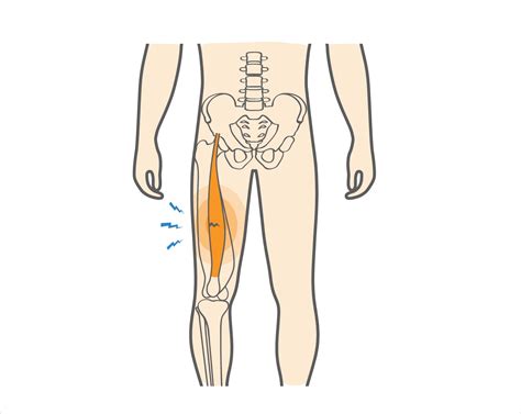 What Is a Quadriceps Strain & How to Speed Up Recovery?