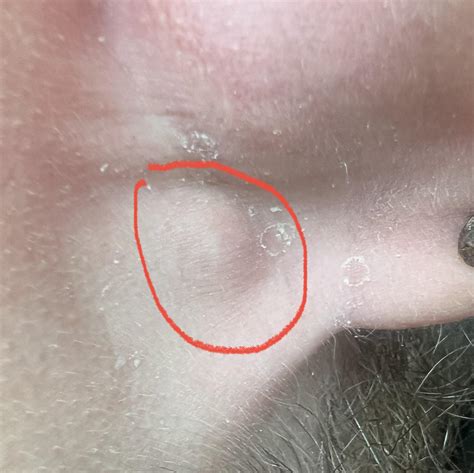 Lump behind ear? Painful to the touch and no idea what it is : r/DiagnoseMe