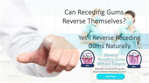 PPT - Reverse Receding Gums Without Surgery PowerPoint Presentation, free download - ID:8215525