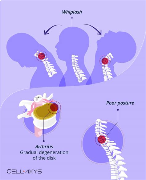 A Stiff Neck & A Weak Stomach: How Neck Pain Can Cause Nausea? - Cellaxys