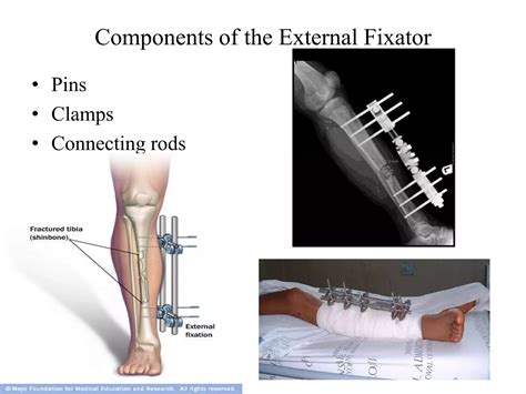 Image result for External Fixation Explained