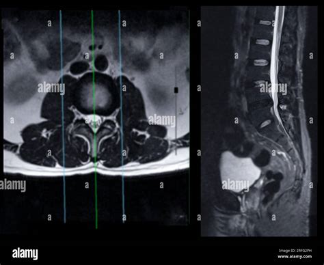 MRI L-S spine or lumbar spine Axial T2W view with sagittal plane for diagnosis spinal cord ...