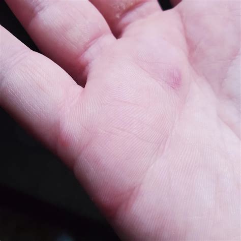 Painful bumps on my hand : r/medical_advice