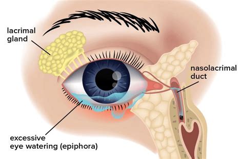 Epiphora: Excessive Eye Watering