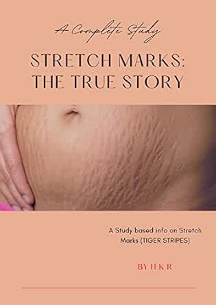 STRETCH MARKS - THE TRUE STORY: A Complete Study Based Info On Stretch ...