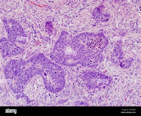 Lung cancer: large cell neuroendocrine carcinoma Stock Photo - Alamy