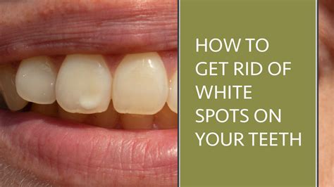 Getting Rid Of White Spots On Your Teeth » Woodborough House Dental ...