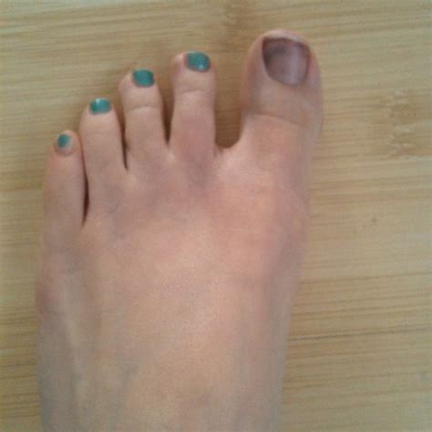 Bruise Under the Big Toenail Treatment: *Secrets Shared by a Podiatrist!*
