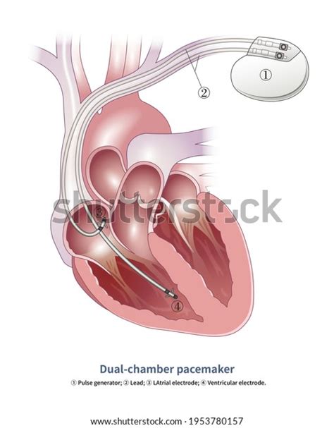 Pacemaker Procedure 的图像结果
