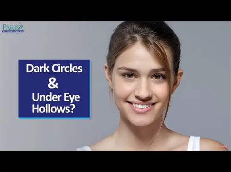 Dark Circles & Under Eye Hollowness Treatment | Home Tips & Treatments
