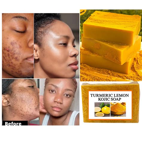 Turmeric Soap Acne at Tayla Bruton blog