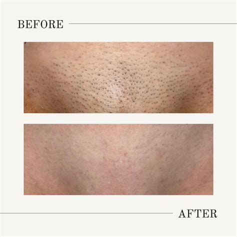 Brazilian Laser Hair Removal Before And After Photos