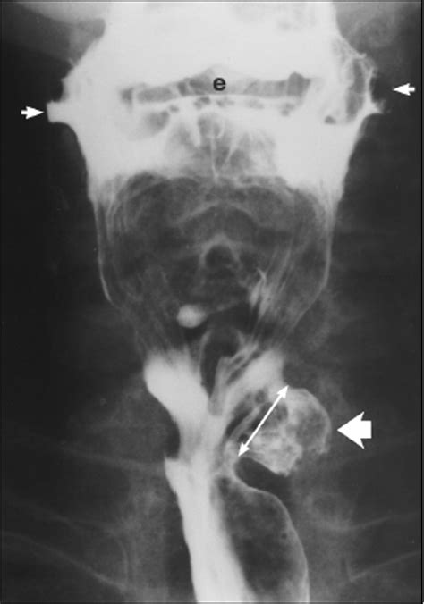Killian Jamieson Diverticulum Laimer's Diverticulum, A Rare True