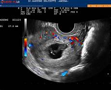 gestazionale senza embrione cause gestazionale senza embrione cause