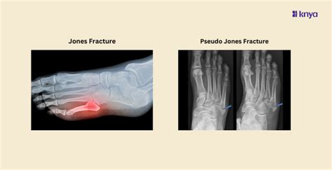 Learn the Difference Between Jones and Pseudo Jones Fracture – Knya