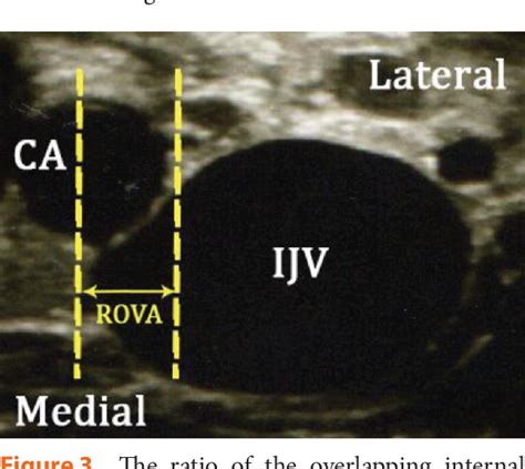 Image result for Contralateral Head Rotation
