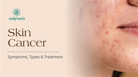 Skin Cancer: Symptoms, Types & Treatment Options