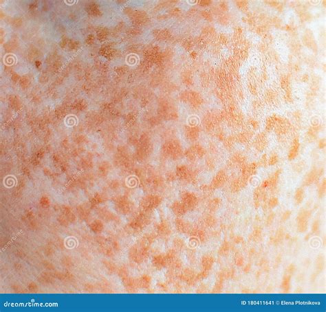 Skin with Red Freckles, Close-up, Macro Stock Image - Image of fragment, cosmetics: 180411641