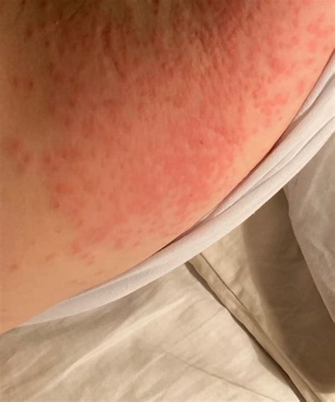 Image result for Moth Rash