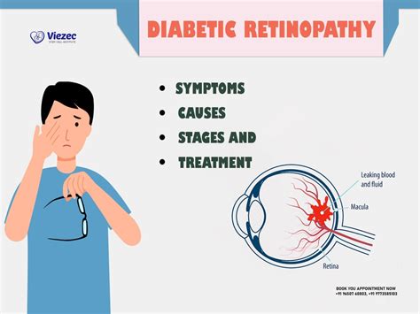 Diabetic Retinopathy Stages