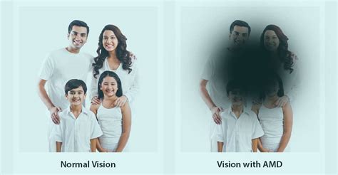 Image result for Visual Problems