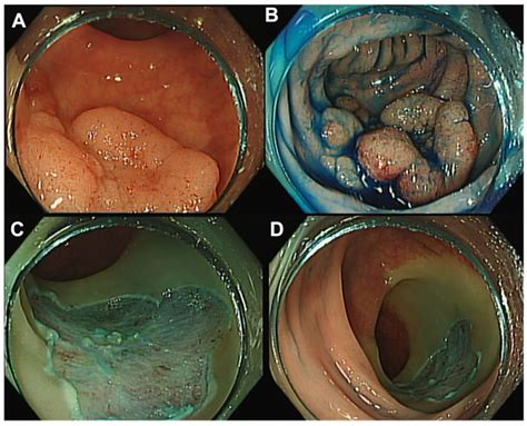 Endoscopic Submucosal Dissection, Endoscopic Mucosal Resection, and ...