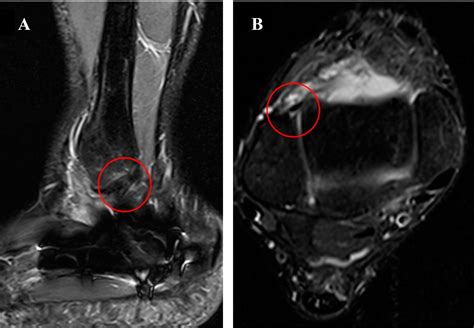 Intra-articular fracture of the calcaneus associated with injury to lateral collateral ligaments ...