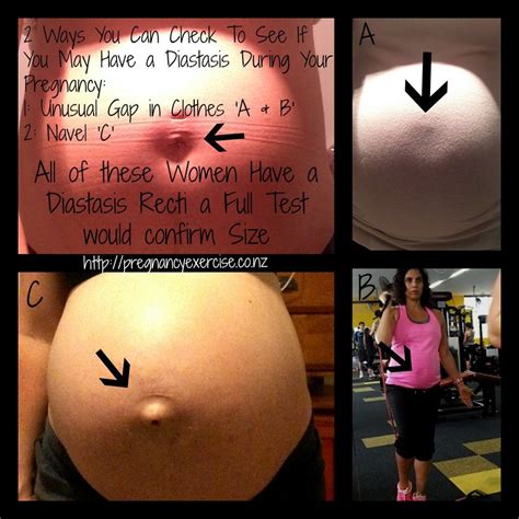 Abs Separating During Pregnancy at Arthur Richer blog