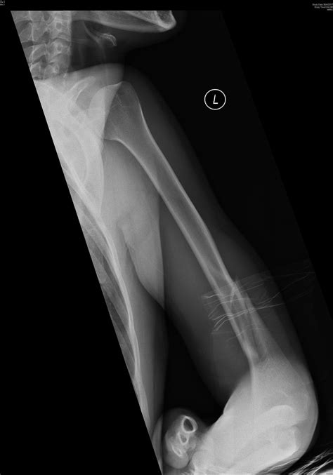 Distal Humerus Fractures - Trauma - Orthobullets