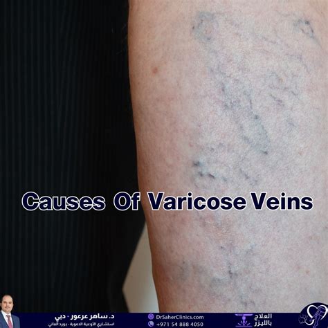 Causes of Varicose Veins