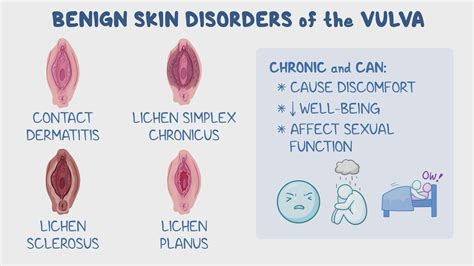 Vulvovaginal Disorders