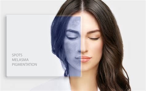 Serum Tran-Az, Mode of Action on Pigmentation – Ozone Signature India