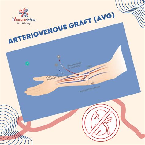 Vascular Access For Haemodialysis - Vascular Info