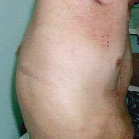 Image result for Axillary Abscess