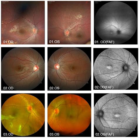 GUCY2D-Associated Retinopathy: A Comparative Study Between Humans and ...