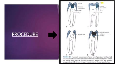 Image result for Difference Between Direct and Indirect Pulp Capping