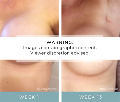Radiation Invasive Ductal Carcinoma Before + After NeoGenesis