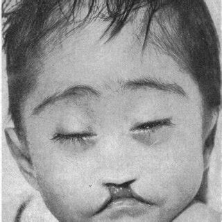 Image result for Transillumination Normal Head