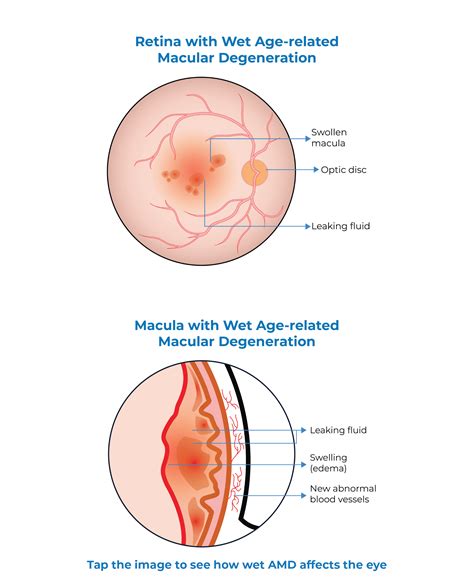 WAMD - Wet Age Related Macular Degeneration - Kodiak Sciences