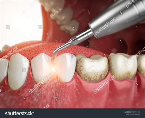 Teeth Cleaning: Over 18,542 Royalty-Free Licensable Stock Illustrations & Drawings | Shutterstock